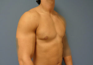 Gynecomastia Before & After Pictures in Nashville, TN