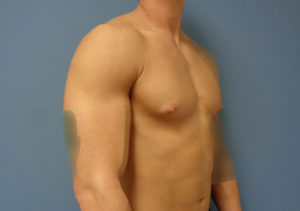 Gynecomastia Before & After Pictures in Nashville, TN