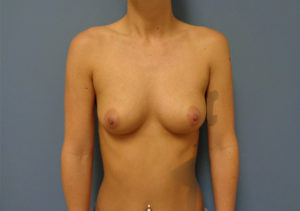 Breast Augmentation Before & After Pictures in Nashville, TN