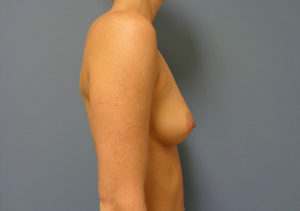 Breast Augmentation Before & After Pictures in Nashville, TN