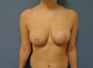 Breast Reduction Before & After Pictures in Nashville, TN