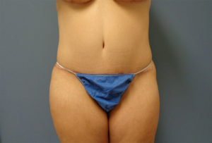 Tummy Tuck Before & After Pictures in Nashville, TN