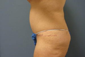 Tummy Tuck Before & After Pictures in Nashville, TN