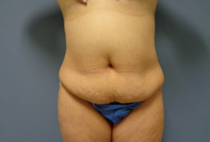 Tummy Tuck Before & After Pictures in Nashville, TN