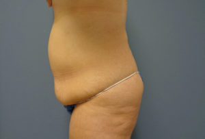 Tummy Tuck Before & After Pictures in Nashville, TN