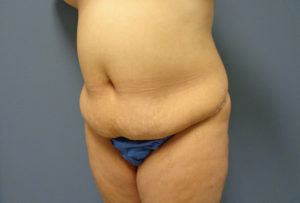 Tummy Tuck Before & After Pictures in Nashville, TN