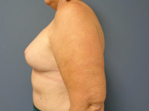 Breast Reconstruction Before & After Pictures in Nashville, TN