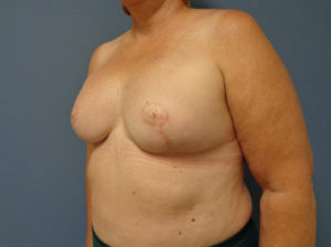 Breast Reconstruction Before & After Pictures in Nashville, TN