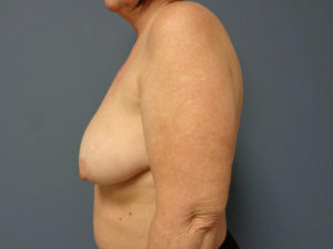 Breast Reconstruction Before & After Pictures in Nashville, TN