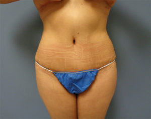 Tummy Tuck Before & After Pictures in Nashville, TN