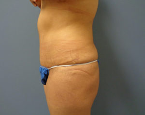 Tummy Tuck Before & After Pictures in Nashville, TN