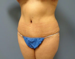 Tummy Tuck Before & After Pictures in Nashville, TN