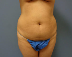 Tummy Tuck Before & After Pictures in Nashville, TN