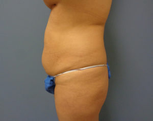 Tummy Tuck Before & After Pictures in Nashville, TN