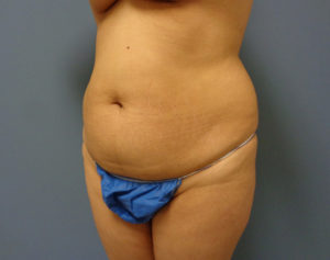 Tummy Tuck Before & After Pictures in Nashville, TN