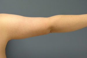 Arm Lift Before & After Pictures in Nashville, TN