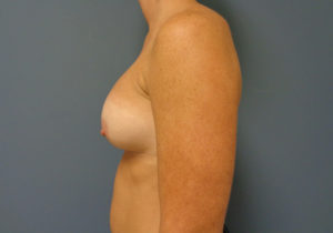 Breast Augmentation Before & After Pictures in Nashville, TN