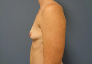 Breast Augmentation Before & After Pictures in Nashville, TN