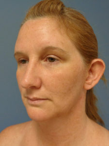 Otoplasty Before & After Pictures in Nashville, TN