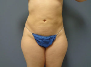 Liposuction Before & After Pictures in Nashville, TN