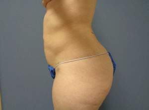 Liposuction Before & After Pictures in Nashville, TN