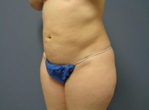 Liposuction Before & After Pictures in Nashville, TN