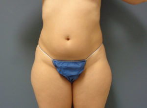 Liposuction Before & After Pictures in Nashville, TN