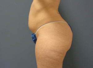 Liposuction Before & After Pictures in Nashville, TN