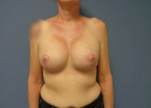 Augmentation with Lift Before & After Pictures in Nashville, TN