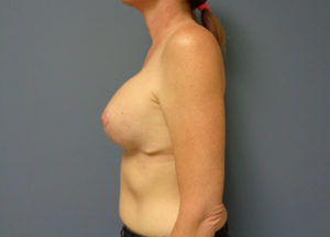 Augmentation with Lift Before & After Pictures in Nashville, TN