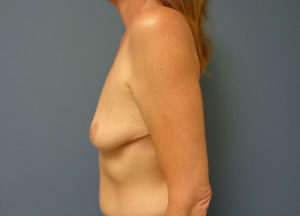 Augmentation with Lift Before & After Pictures in Nashville, TN