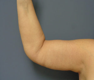 Arm Lift Before & After Pictures in Nashville, TN