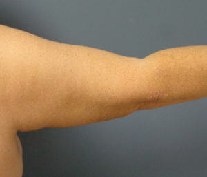 Arm Lift Before & After Pictures in Nashville, TN