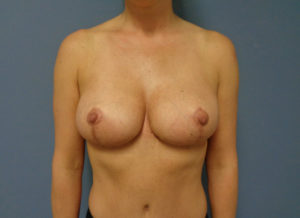 Breast Augmentation with Lift Before & After Pictures in Nashville, TN