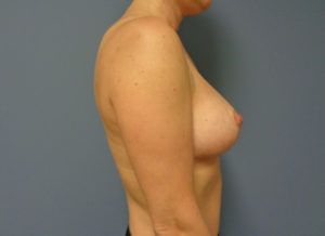 Breast Augmentation with Lift Before & After Pictures in Nashville, TN