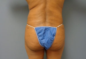 Liposuction Before and After Pictures Nashville, TN