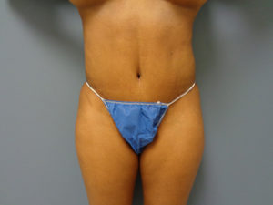 Abdominoplasty - Tummy Tuck Before and After Pictures Nashville, TN