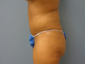 Abdominoplasty - Tummy Tuck Before and After Pictures Nashville, TN
