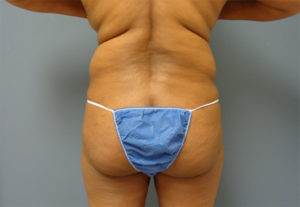 Liposuction Before and After Pictures Nashville, TN