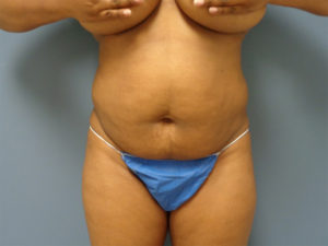 Abdominoplasty - Tummy Tuck Before and After Pictures Nashville, TN