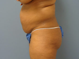 Abdominoplasty - Tummy Tuck Before and After Pictures Nashville, TN