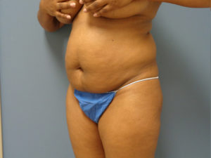 Abdominoplasty - Tummy Tuck Before and After Pictures Nashville, TN