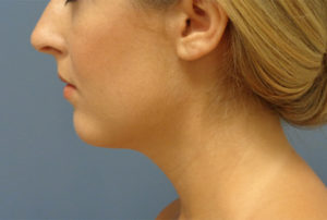 Chin Augmentation Before and After Pictures Nashville, TN