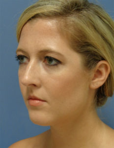 Rhinoplasty Before and After Pictures Nashville, TN