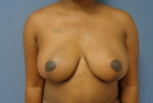 Breast Augmentation with Lift Before and After Pictures Nashville, TN