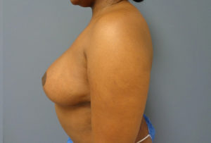 Breast Augmentation with Lift Before and After Pictures Nashville, TN