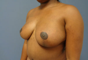 Breast Augmentation with Lift Before and After Pictures Nashville, TN