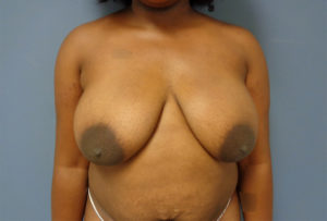 Breast Augmentation with Lift Before and After Pictures Nashville, TN