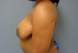 Breast Augmentation with Lift Before and After Pictures Nashville, TN