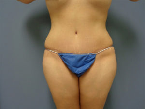 Abdominoplasty - Tummy Tuck Before and After Pictures Nashville, TN